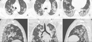 casos positivos As sequelas que a Covid-19 deixa em quem recupera